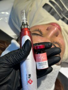 Dermapen1.jpeg